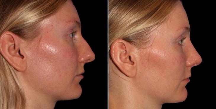 Results Of Scarless Nose Surgery In Atlanta GA Side View